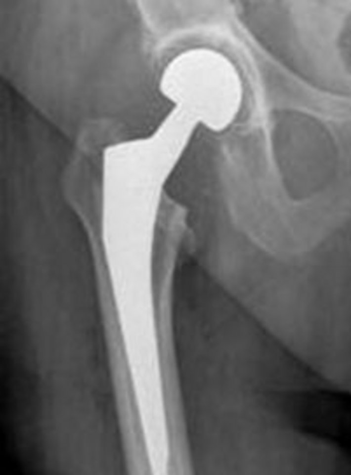 Zementierte Hüftendoprothese