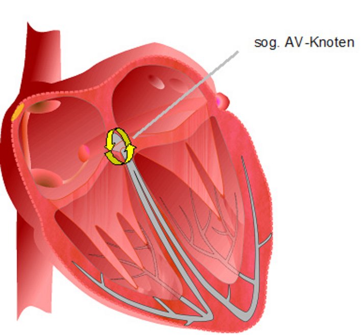 Schema AV-Knoten-Reentry-Tachykardie 