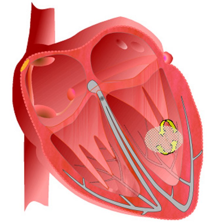 Schema Ventrikuläre Tachykardie