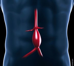 Auf dem Bild ist die menschliche Bauchschlagader zu sehen, welche circa mittig des Oberkörpers verläuft.