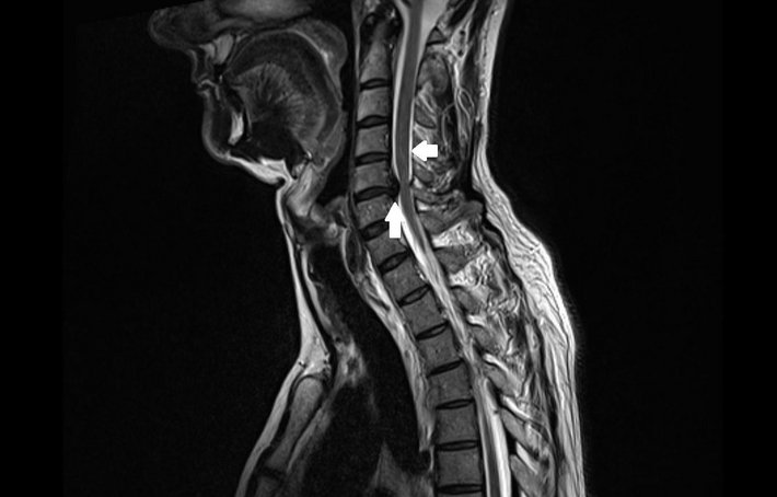Aus dem Bandscheibenfach heraus wölbt sich der Bandscheibenvorfall (links) an der Halswirbeläule nach hinten Richtung Rückenmark (rechts).
