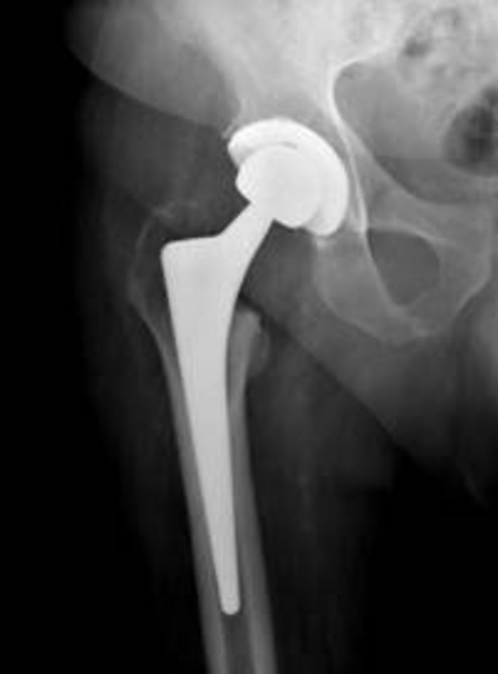 Unzementierte Hüftendoprothese