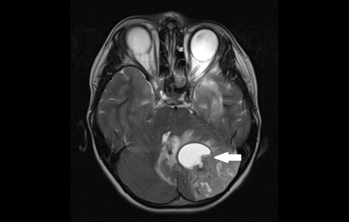 Dieser Hirntumor (dunkel) im Kleinhirn besitzt eine Flüssigkeitsblase (hell), die zusätzlich auf das Hirngewebe drückt.