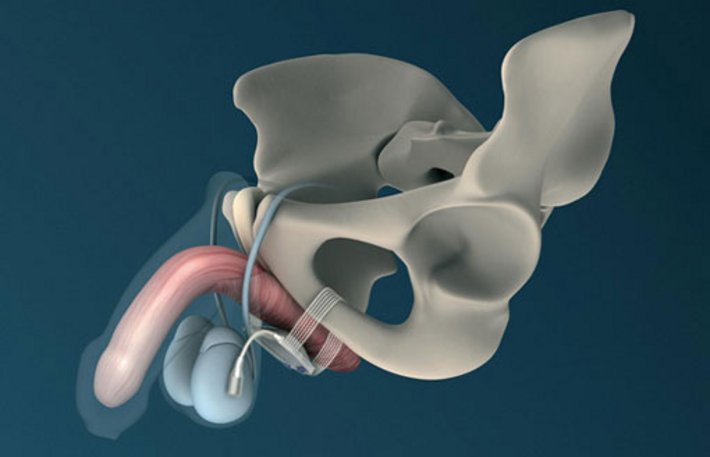 Eine innovative und schonende Behandlung der Inkontinenz nach operativen Eingriffen an der Prostata ist die Implantation eines ATOMS-Systems. 